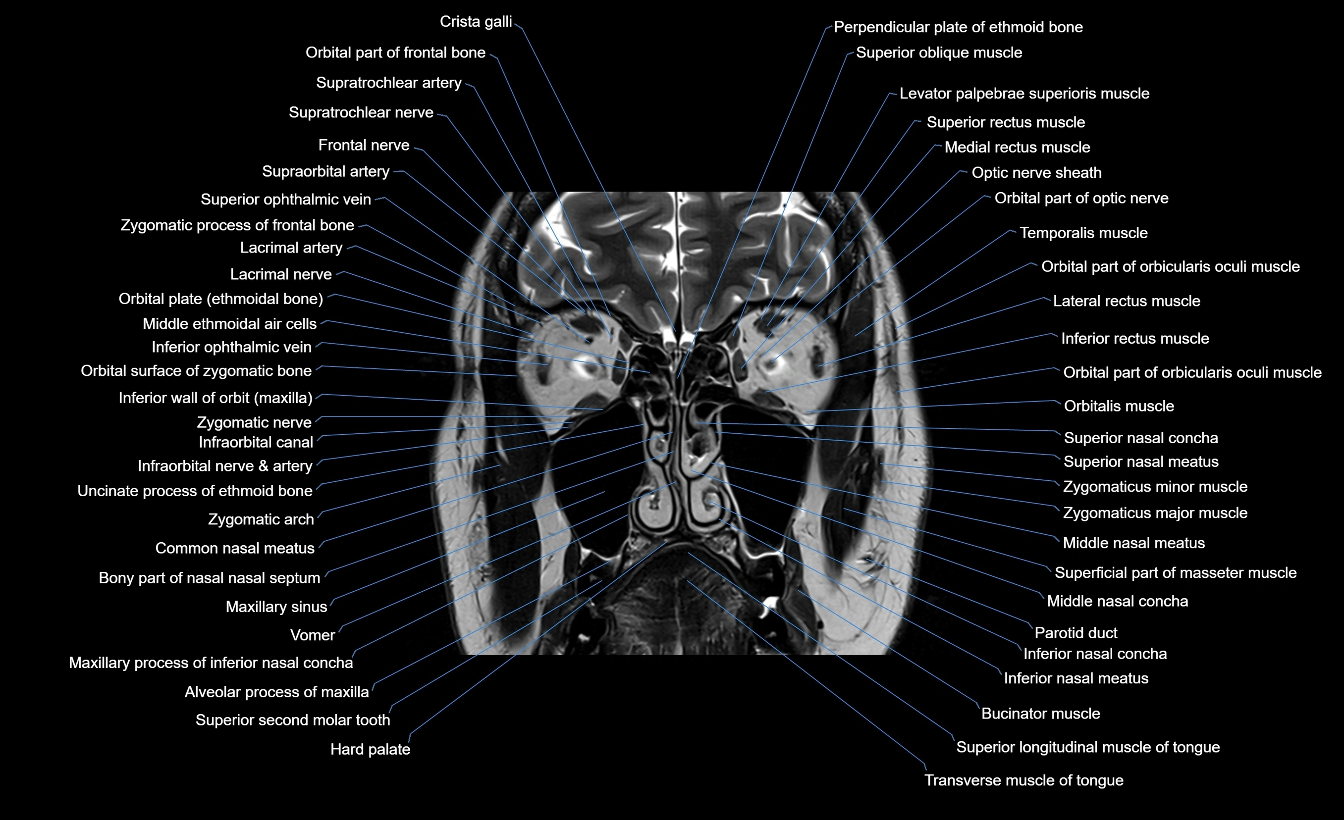 MRI face & paranasal sinuses(PNS) labelled  coronal  cross sectional anatomy 3T radiology  image-img-00001-00022.webp